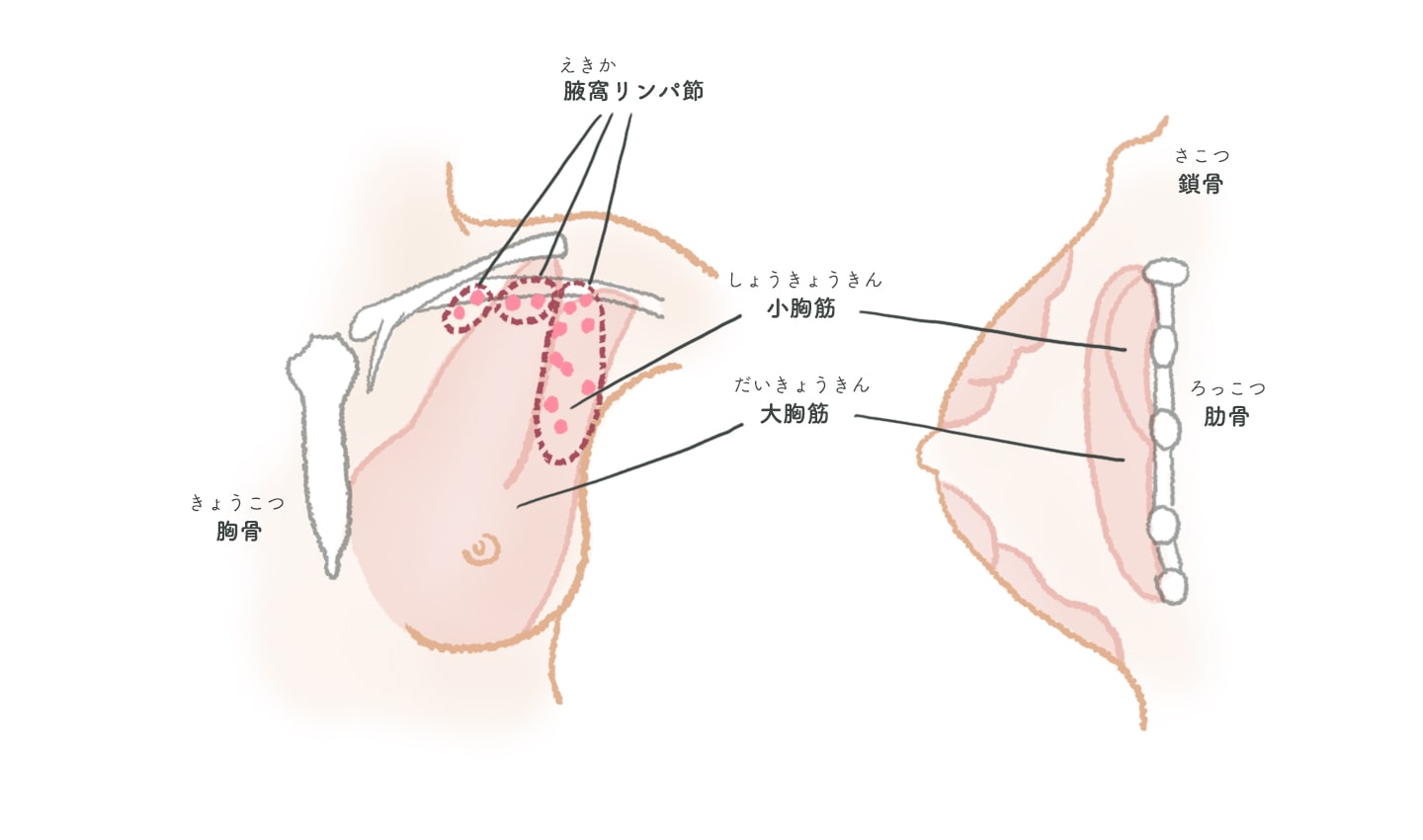 手術について | 治療をはじめる前に | トリプルネガティブ乳がん | 乳がん.jp