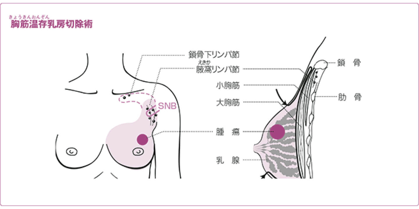 乳房切除術 トリプルネガティブ乳がん 乳がん Jp